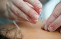 Acupunctuur: een natuurlijke en effectieve oplossing