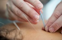 Acupunctuur verslaat migrainepil in nieuw onderzoek
